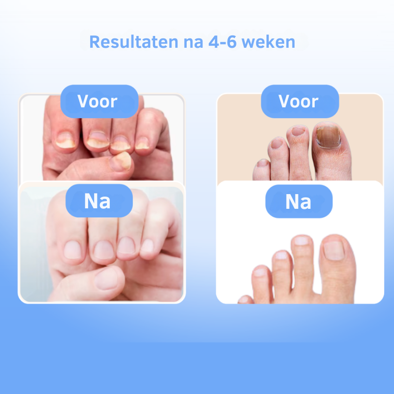 Lasergerät gegen Nagelpilz